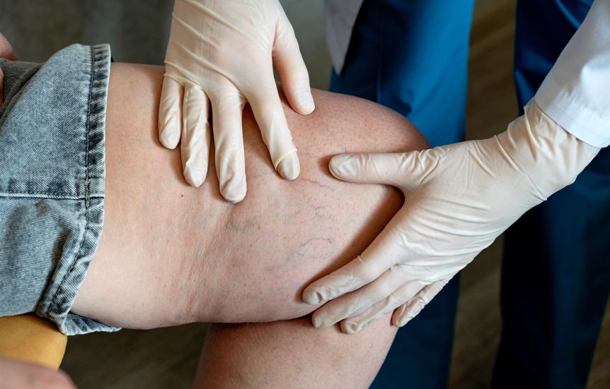 ankara lipödem tedavisi