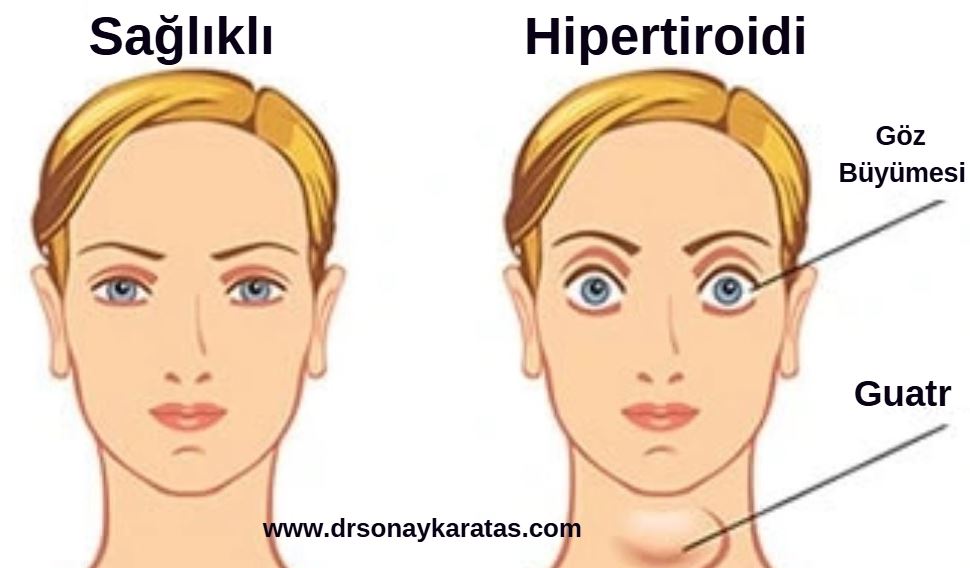 hipertiroidi belirtileri