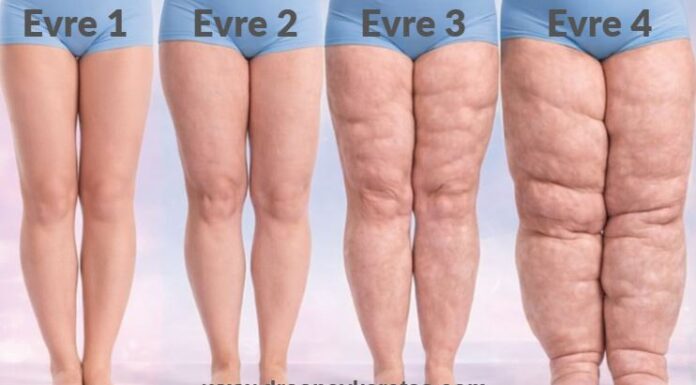Lipödem Evreleri lipödem evreleri
