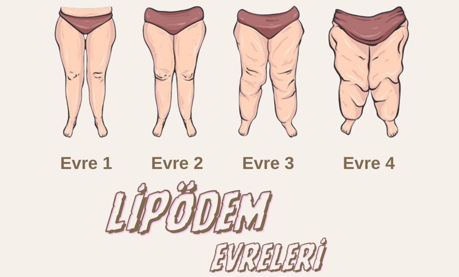 lipödem evreleri