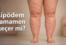 Lipödem Tamamen Geçer mi? lipödem tamamen geçer mi