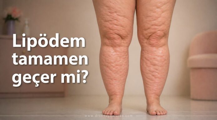 Lipödem Tamamen Geçer mi? lipödem tamamen geçer mi