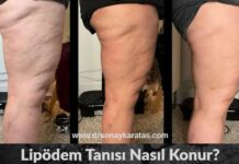 Lipödem Tanısı Nasıl Konur? lipödem tanısı nasıl konur