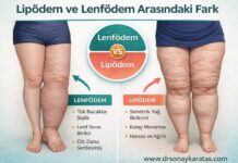 Lipödem ve Lenfödem Farkı Nedir? lipödem ve lenfödem arasındaki fark