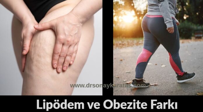 Lipödem ve Obezite Farkı? lipödem ve obezite farkı