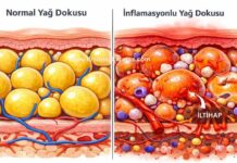 Lipödemde İnflamasyon lipödemde inflamasyon