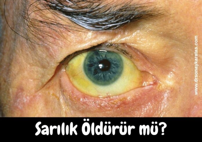 sarılık öldürür mü
