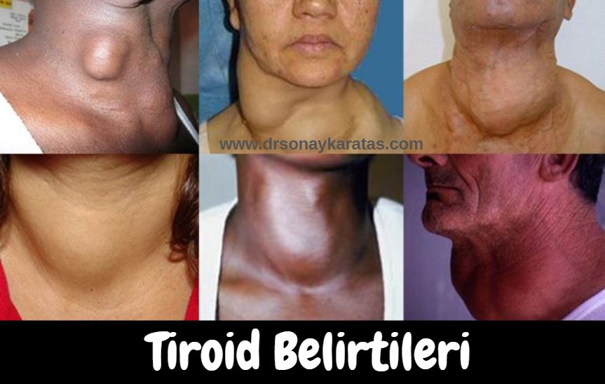 tiroid belirtileri
