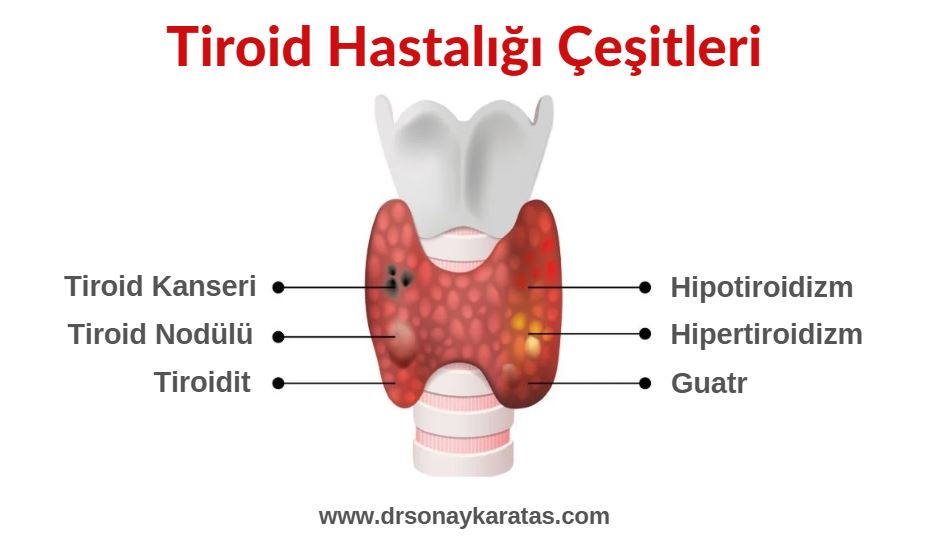 tiroid hastalığı çeşitleri